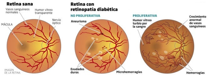 retina-enferma