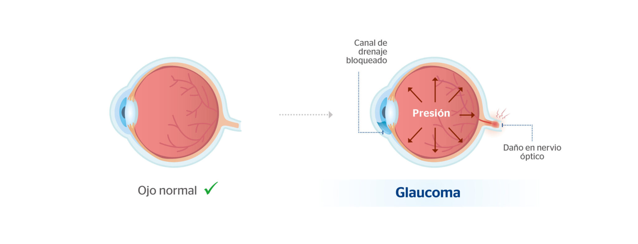 glaucoma